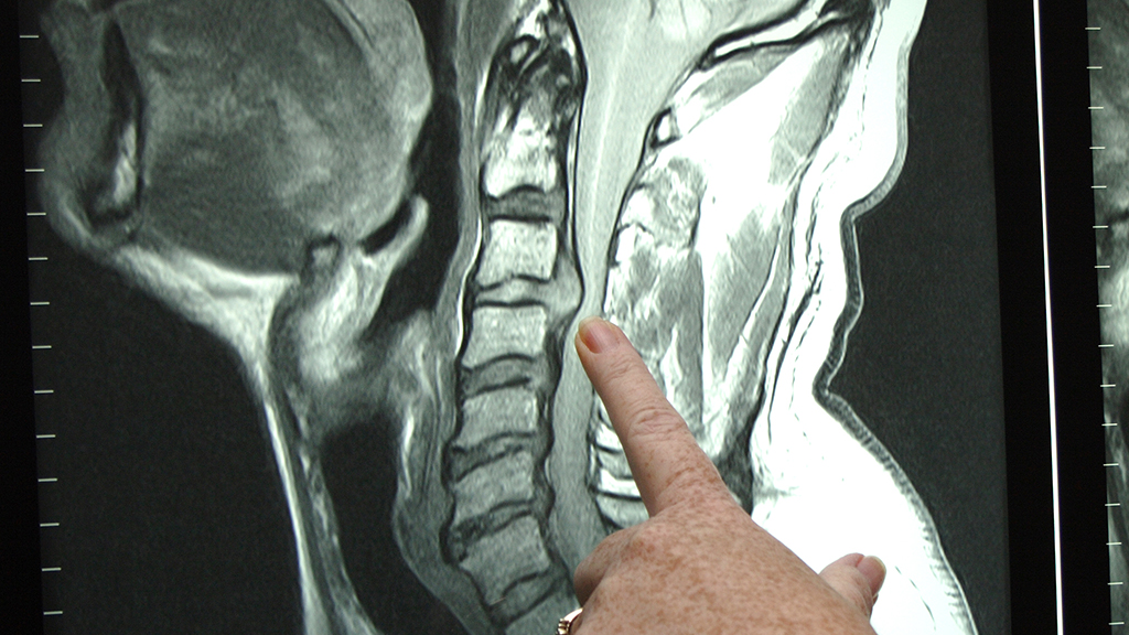 Herniated Disc Bulging Disc Spinal Decompression San Ramon